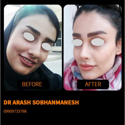 دکتر آرش سبحان منش | جراح زیبایی بینی در شیراز | بهترین جراح بینی در شیراز | جراحی بینی طبیعی در شیراز | جراحی بینی فانتزی در شیراز | جراحی بینی گوشتی در شیراز