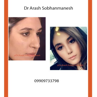 دکتر آرش سبحان منش | جراح زیبایی بینی در شیراز | بهترین جراح بینی در شیراز | جراحی بینی طبیعی در شیراز | جراحی بینی فانتزی در شیراز | جراحی بینی گوشتی در شیراز